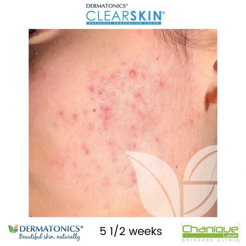 Pimple, acne, zit, blemish Clearskin cream progress 5 & half weeks