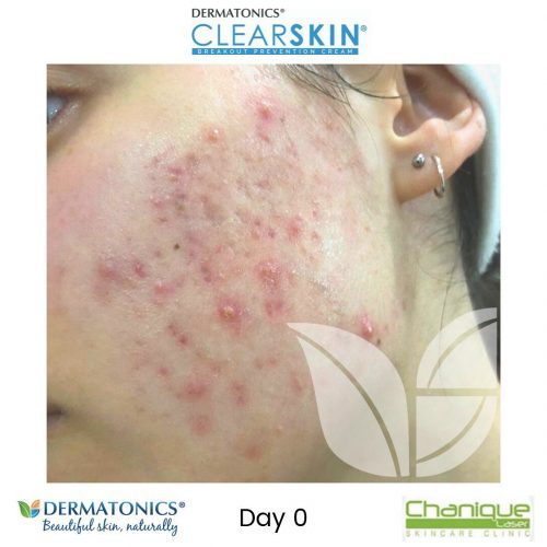 Pimple, acne, zit, blemish Clearskin cream progress Day 0